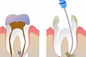 Лечение зуба с удалением нерва